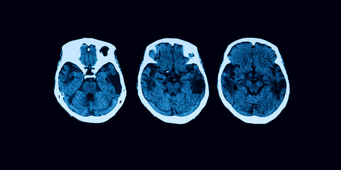 Treating Ischemic Stroke with Transfection